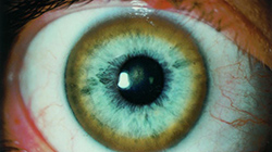 Blue eye showing Kayser-Fleischer ring around iris, a strong symptom of Wilson’s Disease