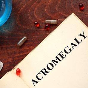 Acromegaly Treatment in Wayne, NJ