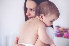 chicken pox treatment in Saddle River, NJ