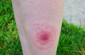 Lyme Disease Rash Pearl, MS