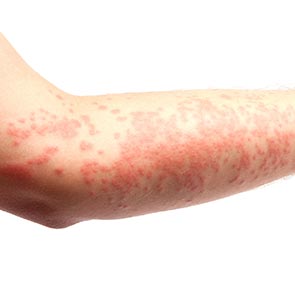 Rocky Mountain Spotted Fever Treatment in Los Angeles, CA